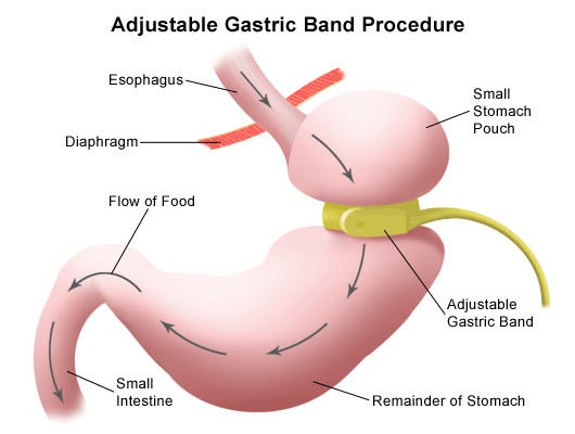 Gastric band hypnosis